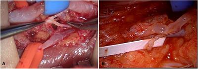 A clinical study of liposuction followed by lymphovenous anastomosis for treatment of breast cancer-related lymphedema